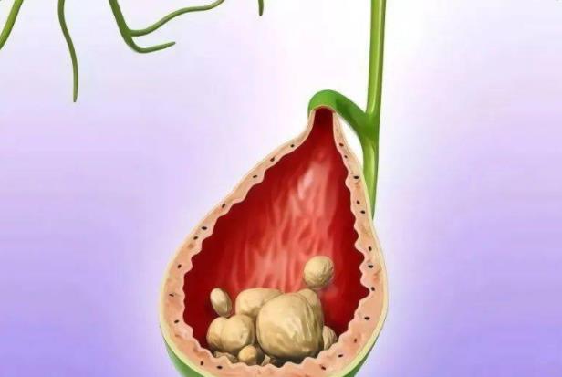 胆结石不能吃的东西有哪些 高胆固醇、脂肪、辛辣、刺激