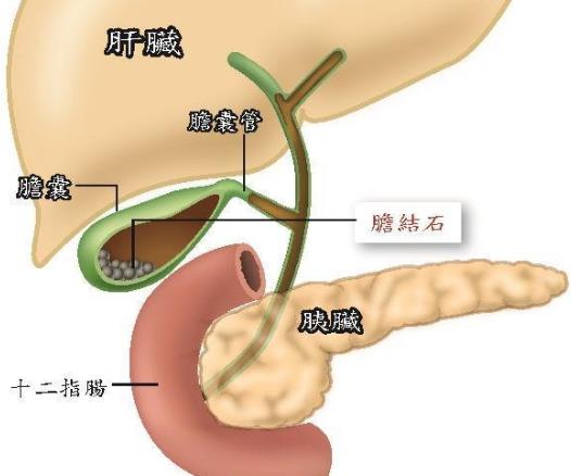 胆结石怎么治疗最好 观察、溶石、手术、饮食调整