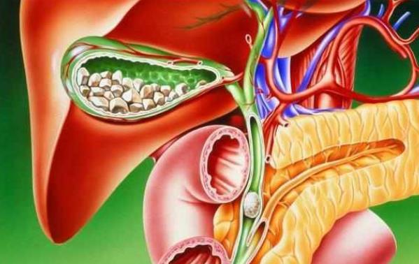 胆结石怎么形成的 胆汁成分失调 淤积胆囊病变