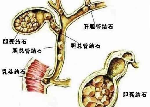 胆结石有什么症状 右上腹疼痛寒战 高热 恶心 厌食