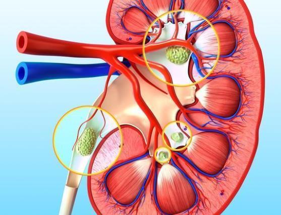 肾结石怎么治疗最好 多喝水 吃药 手术 运动