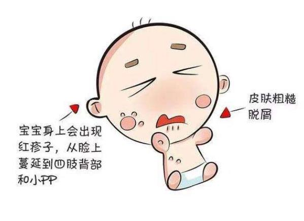 婴儿湿疹多久能好 及时干预治疗 一周左右缓解