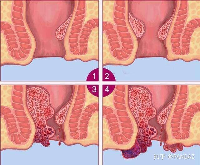 痔疮长什么样子的？痔疮的早期症状，痔疮图片真人图
