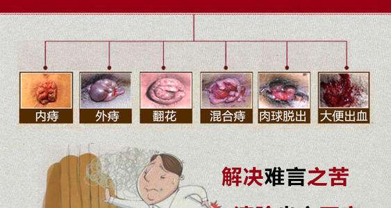 痔疮长什么样子的？痔疮的早期症状，痔疮图片真人图