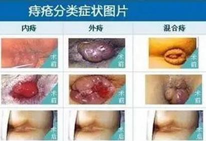 痔疮长什么样子的？痔疮的早期症状，痔疮图片真人图