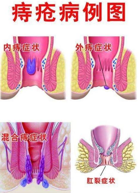 痔疮长什么样子的？痔疮的早期症状，痔疮图片真人图