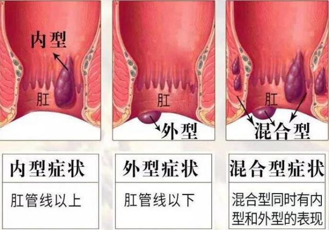 痔疮长什么样子的？痔疮的早期症状，痔疮图片真人图